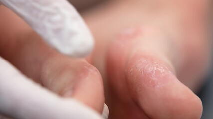 Acute symptomatic rashes of dyshidrotic eczema on patient's feet, toes being infected with dermatitis caused by stress, allergy reaction or moisture, many itchy fluid-filled blisters drying and