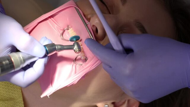 Close-up of dentist polishing composite fillings with rubber dental polishers. Final smoothing and shine enhancement of restored teeth. Professional restorative dentistry procedure