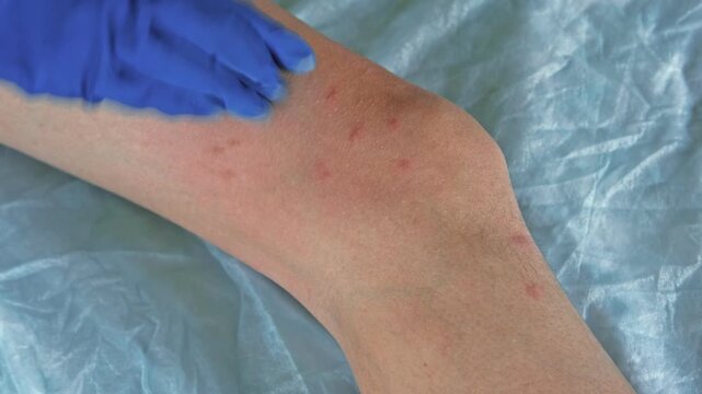 Doctor examining teen girl with bodily red rash. Allergy closeup. Teenager scratches eruption. Nurse applies special cream to atopic skin. Dermatitis, irritation, hive. Pruritus. Mosquito, flea bites
