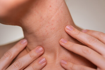 Close-up of young woman's neck with small acne and skin texture, touched by hands. Hormonal...