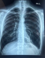 Left-Sided Pneumothorax with Collapsed Lung on Chest X-ray (PA View)