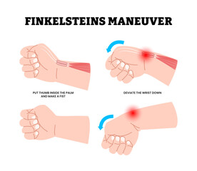 Finkelstein's Maneuver Test Steps. Hand Clinical test for diagnose De Quervain's tenosynovitis or Inflamed Tendon. Labeled Deviate The Wrist Down and Put Thumb Inside The Palm and Make Fist.