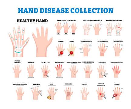 Set of hand disease set collection. Abnormal finger. Raynaud's Syndrome, Osteoarthritis, Anemia, Dyshidrosis, Scleroderma, Paronychia, Cystic Fibrosis, Oedema, Rash, Chilblains, Dermatitis, Eczema