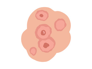 Hand Drawn Erythema Multiforme Redness
