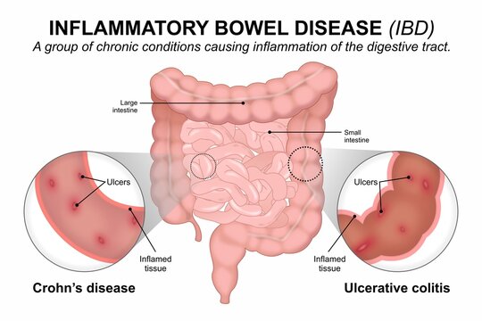 Inflammatory Bowel Disease (IBD) Medical Infographic Flashcard