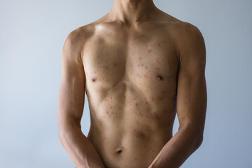 Male torso with allergy rash health concept