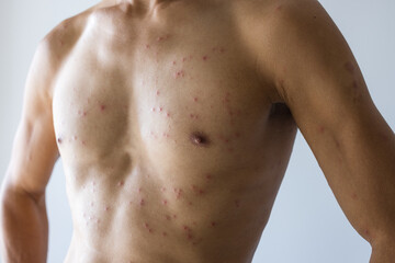 Fototapeta premium Male upper body showing medical skin condition