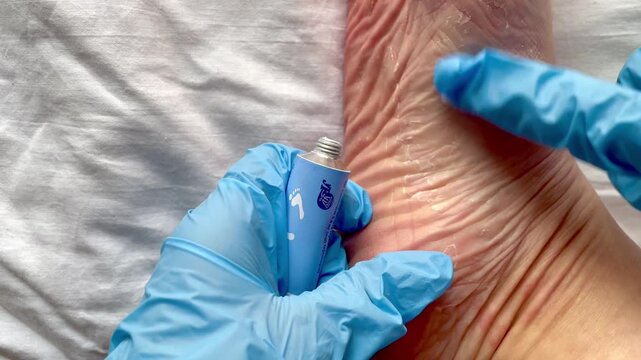 Doctor in blue gloves applying medical ointment or cream on patient's dry heel. Treatment of skin disease, psoriasis, eczema, foot care.