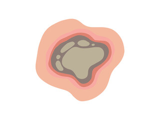 Hand Drawn Necrosis Dead Tissue
