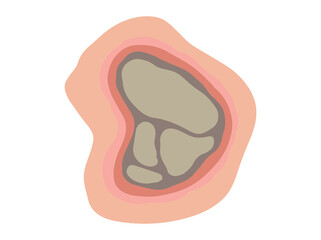 Hand Drawn Necrosis Dead Tissue
