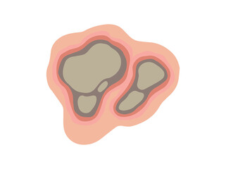 Necrosis Dead Tissue in Skin