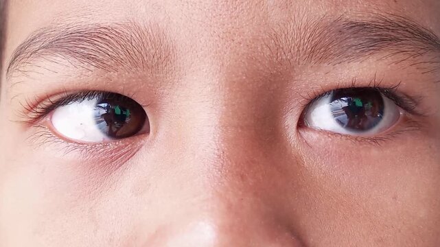 Strabismus in children, medically known as crossed eyes, causes the brain to have difficulty combining images, causing double vision. This is caused by a disorder in the muscles that move the eyeballs
