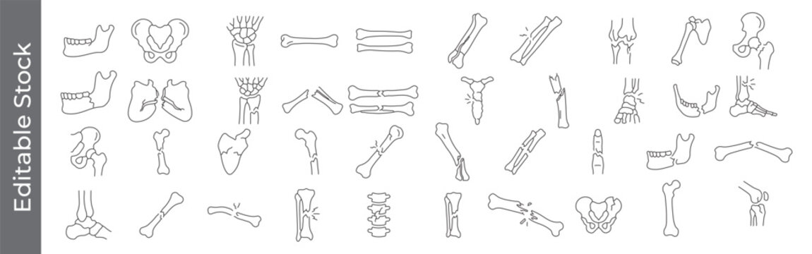 Bone fracture and joint anatomy icon set &ndash; editable outline symbols of broken bone, joint, pelvis, femur and skeletal injury