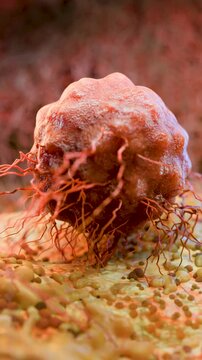 Cancer Cell Growth and Metastasis, Tumor Infection and Invasive Inflammation, Cancerous Cells Spreading Over Tissue, Viral Infection and Lymphocytes in Cancer Immunotherapy, 3D Medical Illustration Re