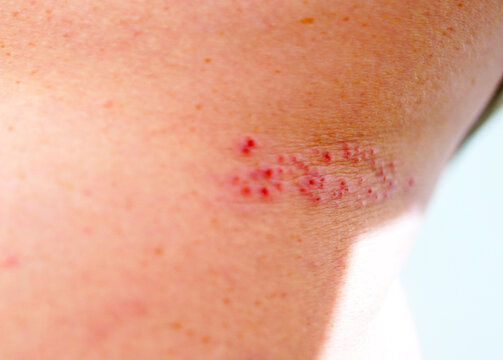 Herpes zoster infection on human skin. Skin disease background. Viral infection on human skin, acne, psoriasis, eczema, herpes, lichen, melanoma.