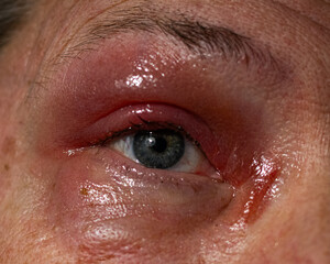 swollen, irritated red eye with inflammation and tearfulness, ideal for medical education,...
