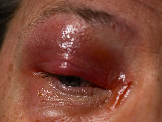 severely swollen, irritated red eye, perfect for medical education, healthcare campaigns, allergy awareness, ophthalmology communication, pharmaceutical visuals, and realistic wellness-related content