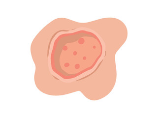 Ulcer Open Sore in Skin
