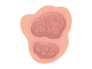 Hand Drawn Tumor Solid Mass

