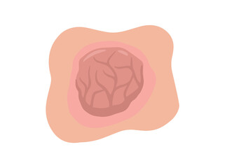 Tumor Solid Mass in Skin
