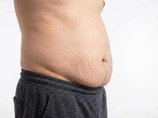 Naklejka premium Close-up of a person's midsection showing a protruding abdomen with stretch marks, indicating weight gain