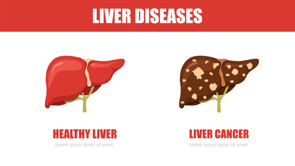 Liver disease. Healthy and cancer liver. Internal organ icons. Medical illustration. Vector design.