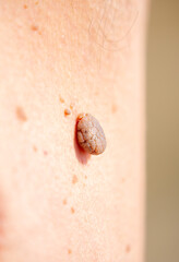Nevus close-up. Mole on human skin. Irregular birthmark.