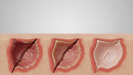 Healing Wound Stages on Human Skin.
