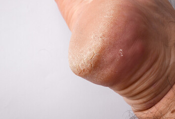 Fototapeta premium Cracked skin on the heel close up. Man's leg