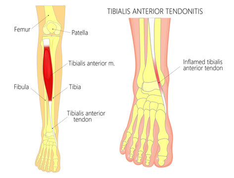Anterior ankle injury. Tibialis anterior tendonitis problem. Front view