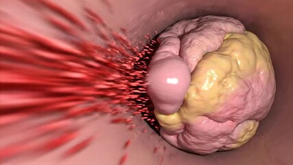 Close Up View Of A Brain Tumor With Surrounding Red Particles Flowing Rapidly In A Medical Tunnel