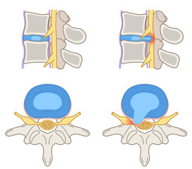 腰椎椎間板ヘルニア　椎間板の構造　腰痛