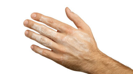 Close up of a hand with vitiligo, showing depigmentation patches on the skin, isolated on a transparent background, providing a clear view of the condition's effects