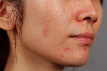 Obraz premium Extreme Close-up of Young Asian Woman's Face with Severe Acne, Redness, and Sensitive Skin Texture, Dermatological Problem Concept