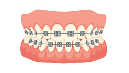 Illustration of human teeth with traditional metal braces for orthodontic treatment, showcasing a healthy smile and dental care concept.