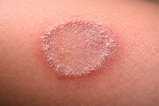 Photorealistic 3D medical depiction of tinea corporis (ringworm), extreme close-up macro of a single round annular plaque on skin, raised scaly active border with fine dry white scale