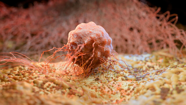 Cancer Cell Growth and Metastasis, Tumor Infection and Invasive Inflammation, Cancerous Cells Spreading Over Tissue, Viral Infection and Lymphocytes in Cancer Immunotherapy, 3D Medical Illustration Re