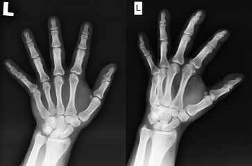 Actual X-rays of the man's left hand. Two views of the healthy hand.