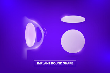 Breast silicone implant round shape type in woman chest silhouette, vector infographic after mammoplasty plastic surgery