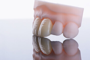 High-quality naturally dental single crowns made of zirconium for fixation to the frontal teeth of upper jaw. © gorynvd