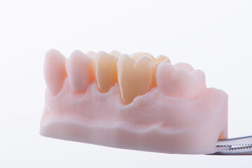 High-quality naturally dental single crowns made of zirconium for fixation to the teeth of upper jaw. © gorynvd
