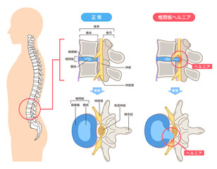 腰椎椎間板ヘルニア　椎間板の構造　腰痛