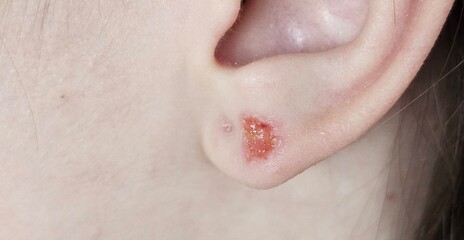 Fototapeta premium Skin irritation near ear with swelling and discoloration observed in a close-up