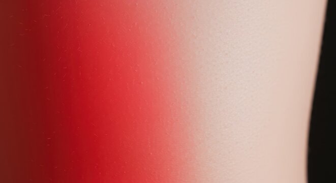 Vivid contrast of painful, bright red skin adjacent to protected white skin, clearly demonstrating the outline created by summer attire exposure, sun, dermatology, vivid