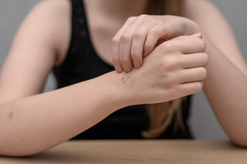 Woman scratching herself, scab on her arm, stress and nerves, dermatillomania