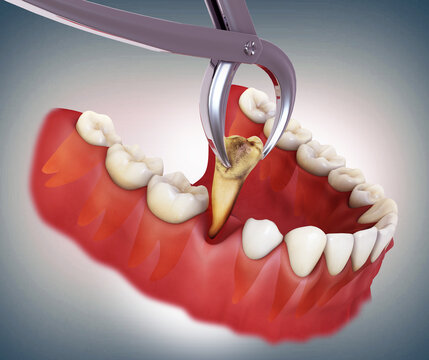 Caries damaged the tooth entirely&hellip; and following that tooth is being extracted with the help of a dental instrument.