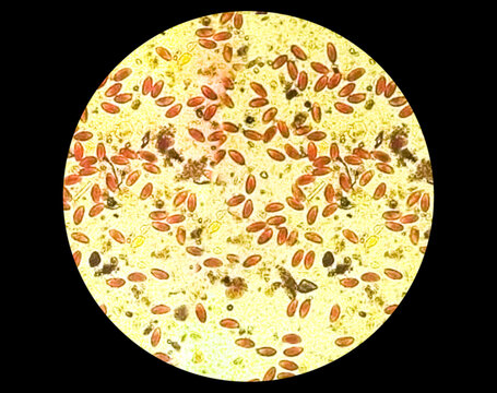 Enterobius vermicularis (EV) pinworm eggs. Parasite in stool specimen under light microscope. 