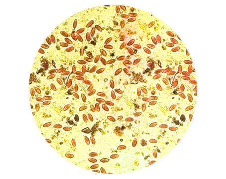 Enterobius vermicularis (EV) pinworm eggs. Parasite in stool specimen under light microscope. 