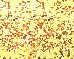 Enterobius vermicularis (EV) pinworm eggs. Parasite in stool specimen under light microscope. 