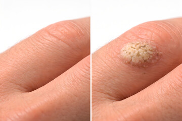 Photorealistic 3D depiction of common warts on the hand, close-up of knuckles and fingers showing several small rough hyperkeratotic papules with a slightly raised cauliflower-like surface